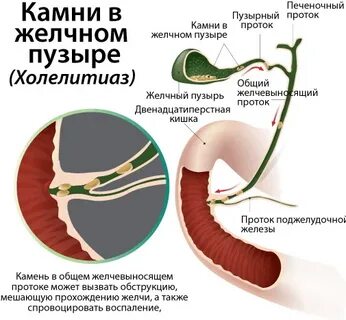 Камни после удаления желчного