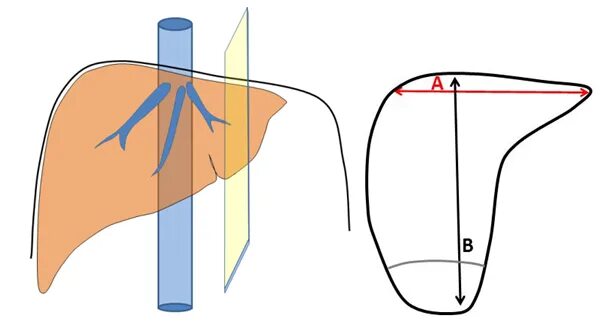 Край печени закруглен. КВР размер правой доли печени. Косой вертикальный размер печени. Косо вертикальный размер печени. Размеры печени КВР.