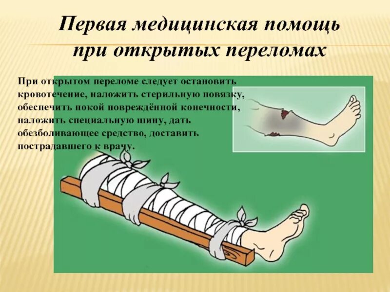 Артериальное при открытом переломе