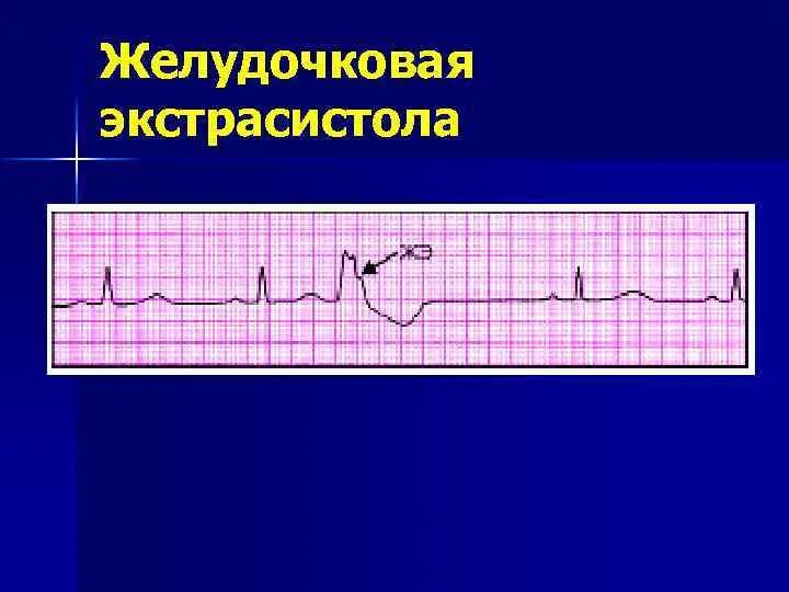 Желудочковые экстрасистолы. Полифокусная желудочковая экстрасистолия. Пароксизмальная желудочковая экстрасистолия. Парные полиморфные желудочковые экстрасистолы. Экстрасистолы в минуту