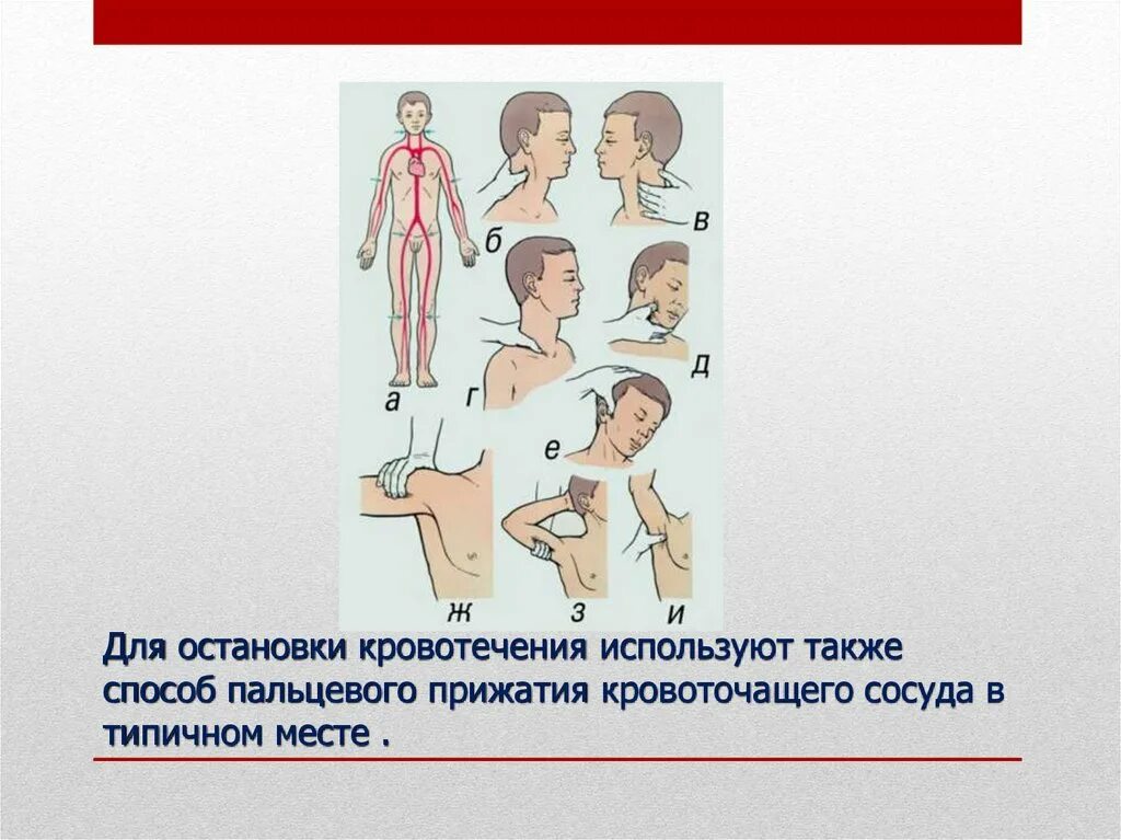 Остановка кровотечения пальцевое прижатие. Пальцевое прижатие артерий при кровотечениях алгоритм. Места прижатия артерий для остановки кровотечения из сосудов. Пальцевое прижатие сосуда в ране.