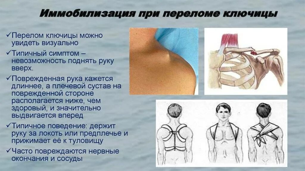 Перелом ключицы у новорожденного. Перелом ключицы у ребенка дезо. Повязка дезо при переломе ключицы у ребенка 3 года. Ключица у новорожденных сломана. Кольца дельбе перелом ключицы кольца.