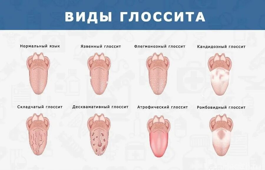 Что означает розовый язык. Глоссит Гюнтера Миллера. Клинико-анатомическую форму глоссита. Гунтеровский глоссит этиология.