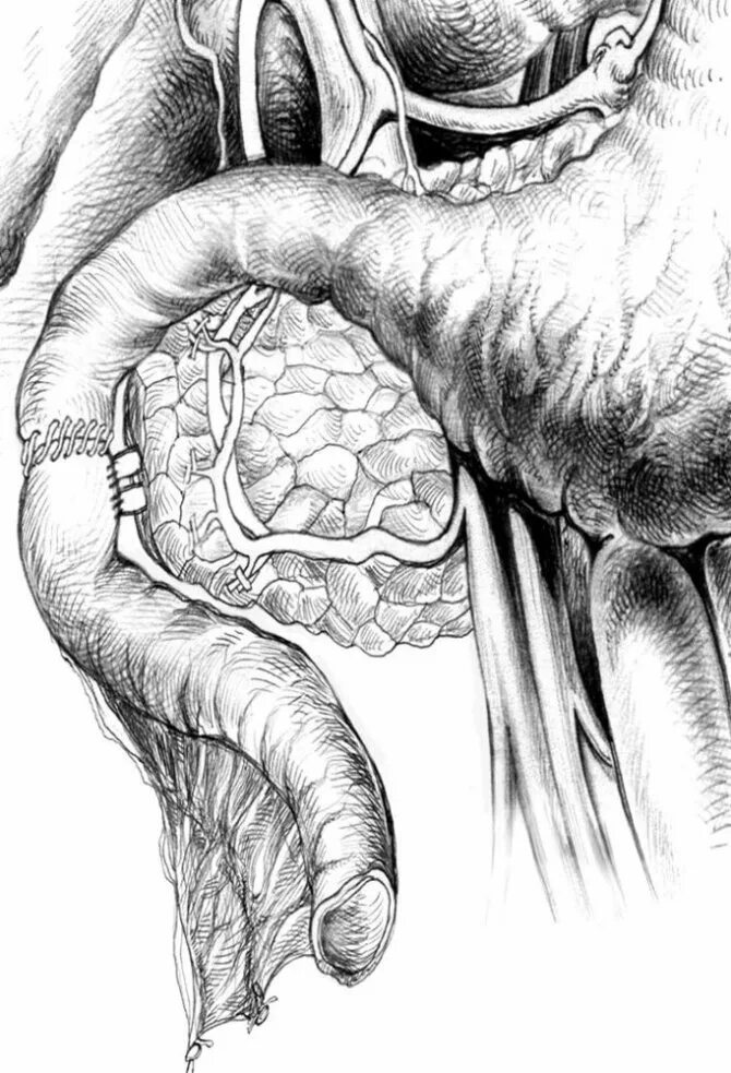Простата кишечника. Двенадцатиперстная инвагинация кишечника. новообразование в двенадцатиперстной кишке. онкология 12 перстной кишки.