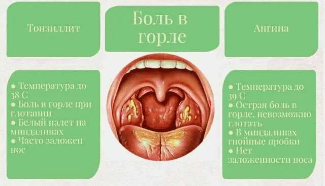 Почему долго болит горло. Почему долго болит горло