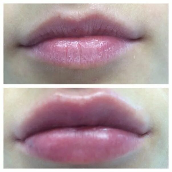 Увеличить губы гиалуроновой кислотой. Контуринг губ гиалуроновой кислотой. Увеличение губ гиалуроновой кислотой. Губы после гиалуроновой кислоты. Контур губ гиалуроновой кислотой 1 мл.