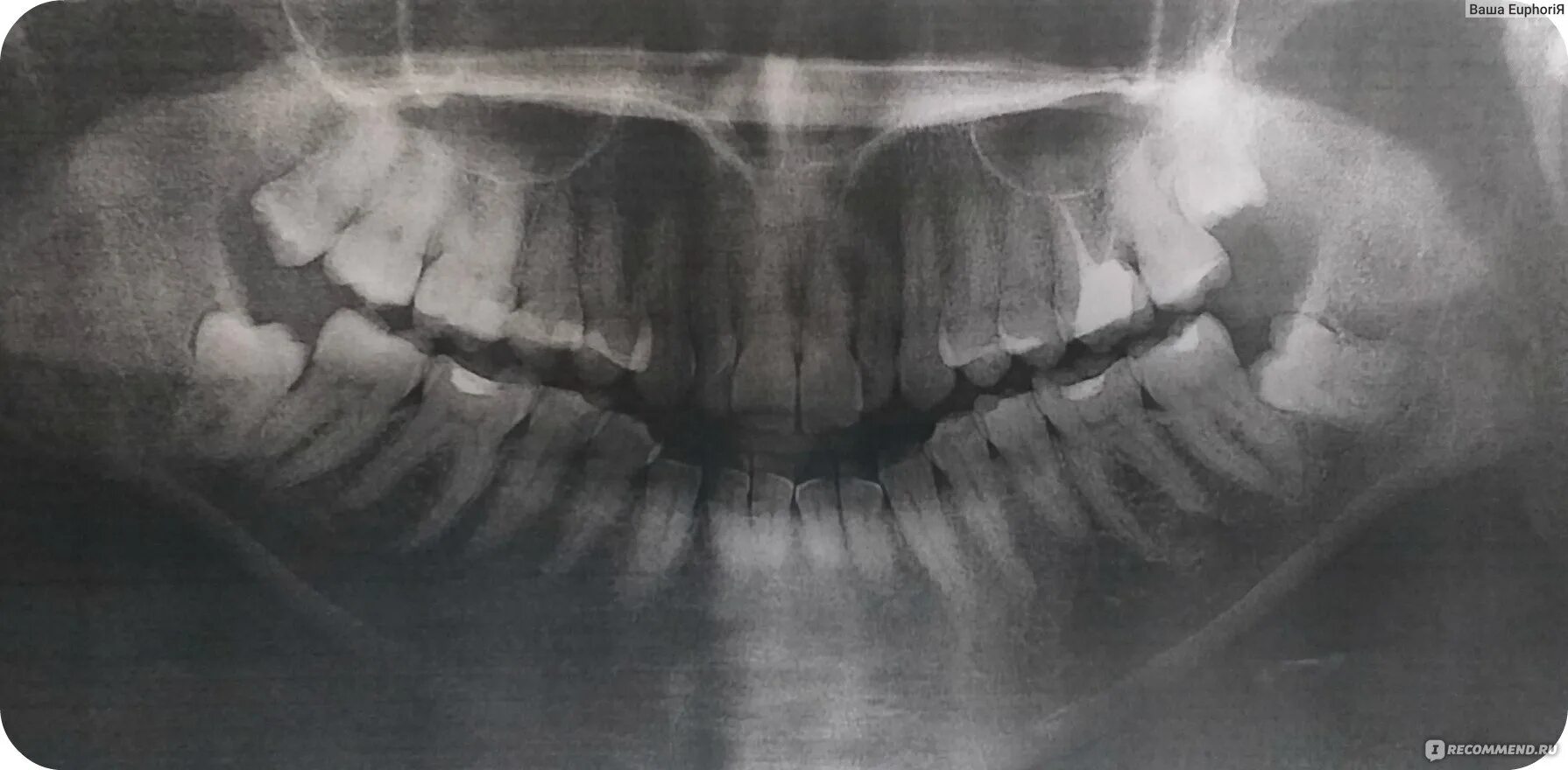 Как заживает лунка после удаления зуба? Фото процесса Стоматология Smile-at-Once