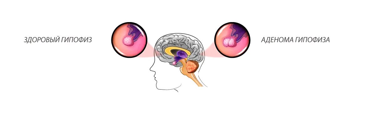 Опухоль гипофиза. Аденома гипофиза рост опухоли. Эндоселлярная аденома гипофиза. Аденома передней доли гипофиза. Аденома гипофиза этиология патогенез клиника.