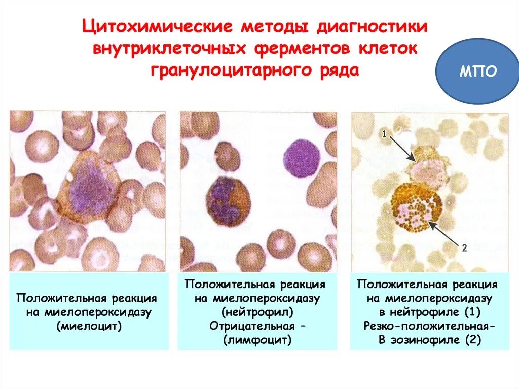 Реакция на лейкоциты положительная. Цитохимические методы исследования клетки. Положительная реакция на миелопероксидазу. Положительная реакция бластных клеток на миелопероксидазу. Цитохимическая реакция на миелопероксидазу.