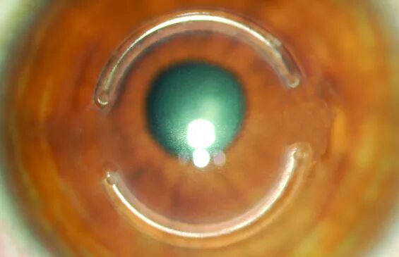 интрастромальные роговичные кольца. кератоконус имплантация колец. острый кератоконус буллы. кольцо флейшера кератоконус. кольцо флейшера кератоконус.