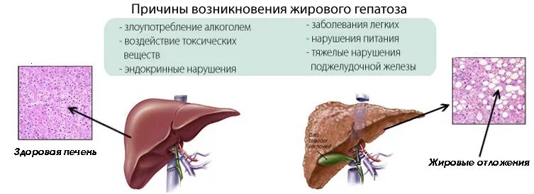 Желчный ожирение