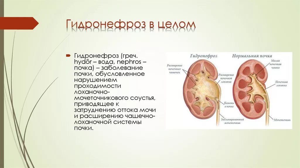 Исход заболеваний почек. Гидронефроз почки патологическая анатомия. Гидронефроз почки патанатомия. Гидронефром почки ПАТ анатомия. Гидронефроз почки макропрепарат.