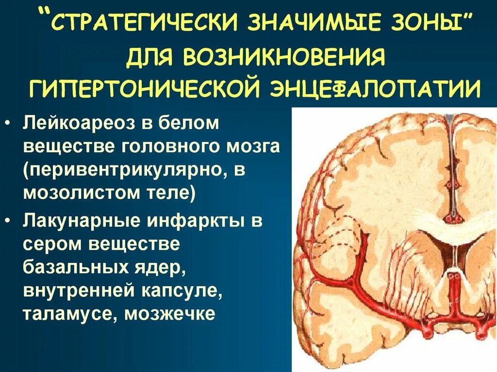Ишемия головного мозга можно вылечить. Зоны ишемии головного мозга. инфаркт мозжечка мрт. гипертензивная энцефалопатия. ишемический очаг в мозжечке.