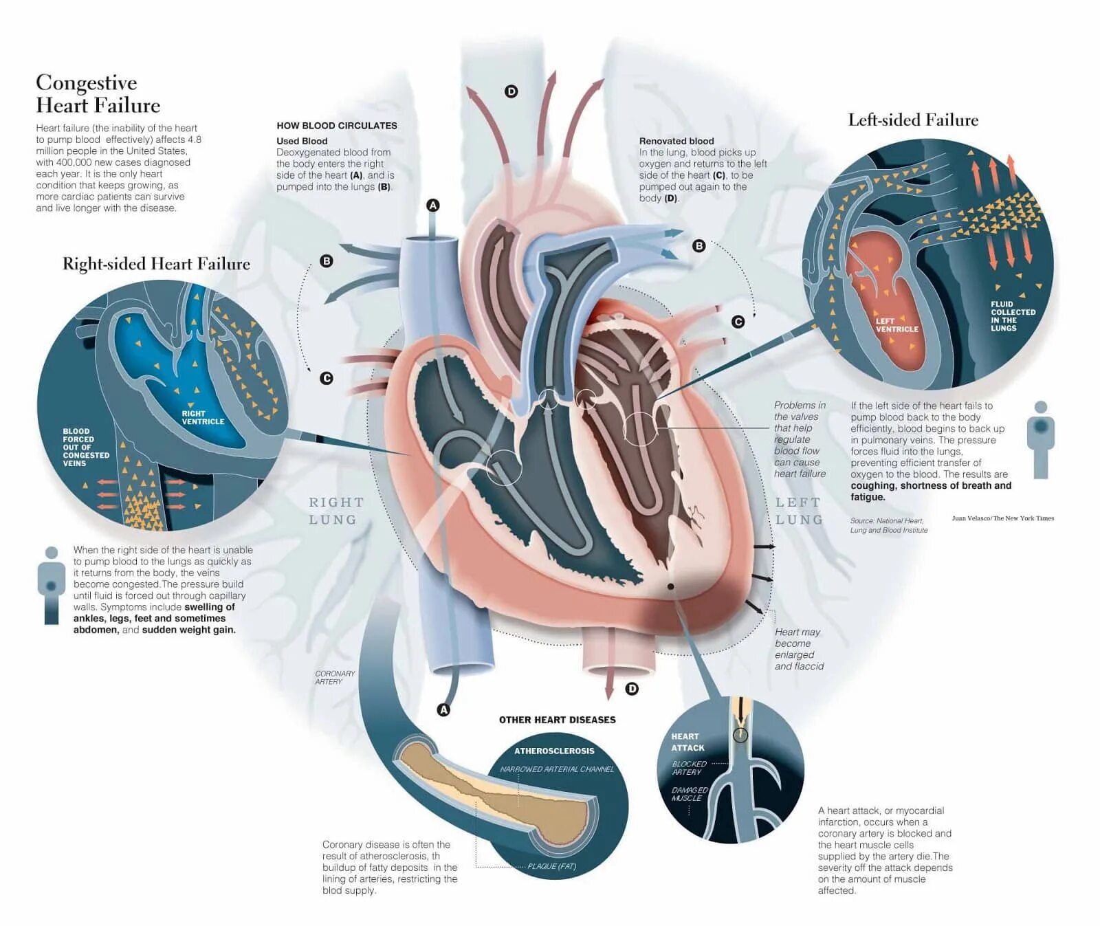 Left sided 2. Left sided 2. Right heart failure. Left sided 2. Декстрокардия узи сердца.
