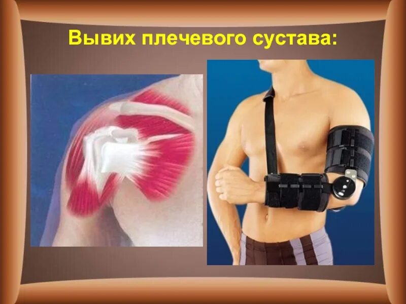 Вывих плечевого сустава как лечить. Подвывих плечевого сустава. растяжение связок плечевого сустава.