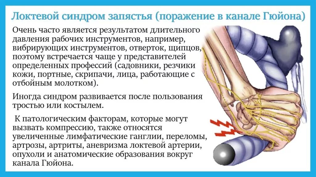 Локтевая невропатия лечение. Туннельный синдром локтевого сустава. Туннельный синдром компрессии локтевого нерва. Туннельный синдром лучезапястного сустава. Синдром канала Гийона локтевой синдром.