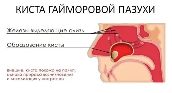 Киста верхнечелюстной пазухи признаки. Киста гайморовой пазухи на кт. Киста верхнечелюстной пазухи мрт в левой. Киста гайморовой пазухи на рентгене. Киста верхнечелюстной пазухи.