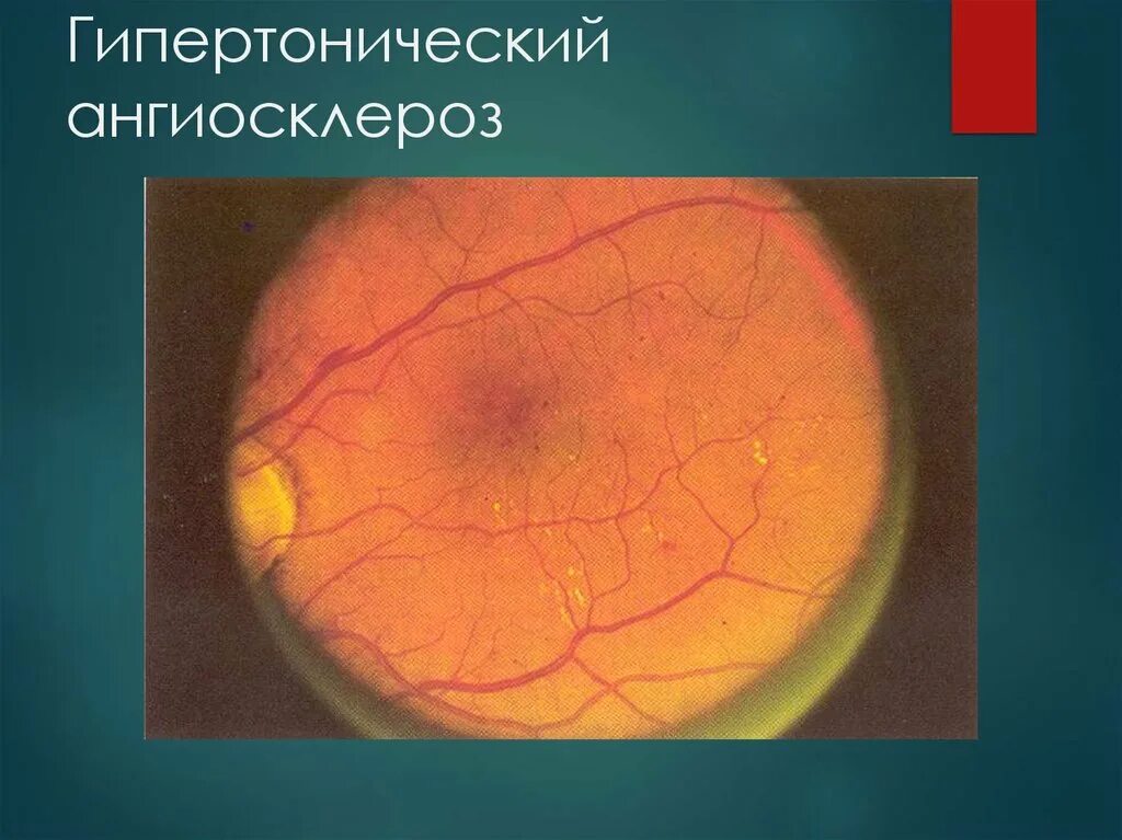 Ангиосклероз сетчатки лечение. Гипертонический ангиосклероз сетчатки. изменения глазного дна при гипертонической болезни.