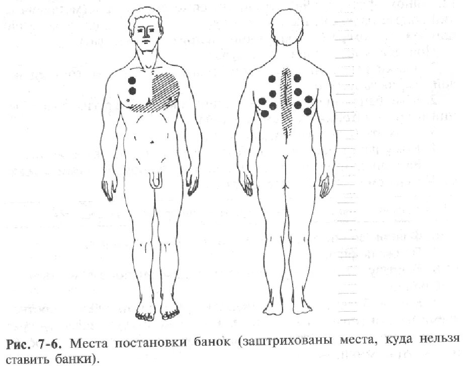 На сколько ставят банки взрослым. Схема постановки банок при пневмонии. Места постановки медицинских банок. Постановка вакуумных банок. Постановка банок места постановки.