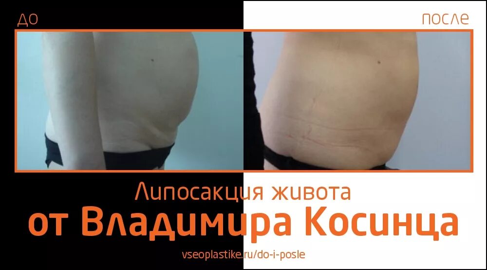Тумесцентная липосакция живота. Отзывы после липосакции живота. Лазерная липосакция боков. Отзывы после липосакции живота. Ультразвуковая липосакция vaser.