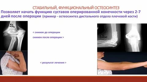 Перелом плечевой кости после операции