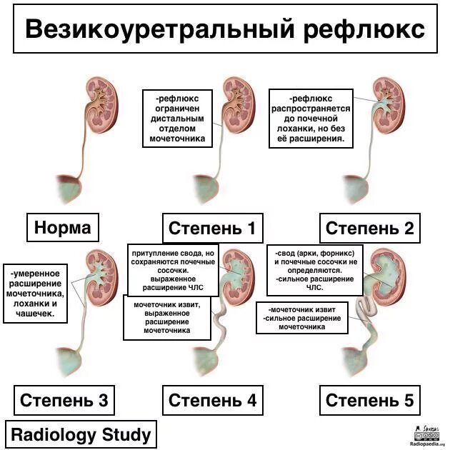 Цистит у женщин симптомы. Ребенок давит на мочевой пузырь при беременности. Боли при цистите у женщин. При зачатии частые мочеиспускания. Мегацистис мочевого пузыря.