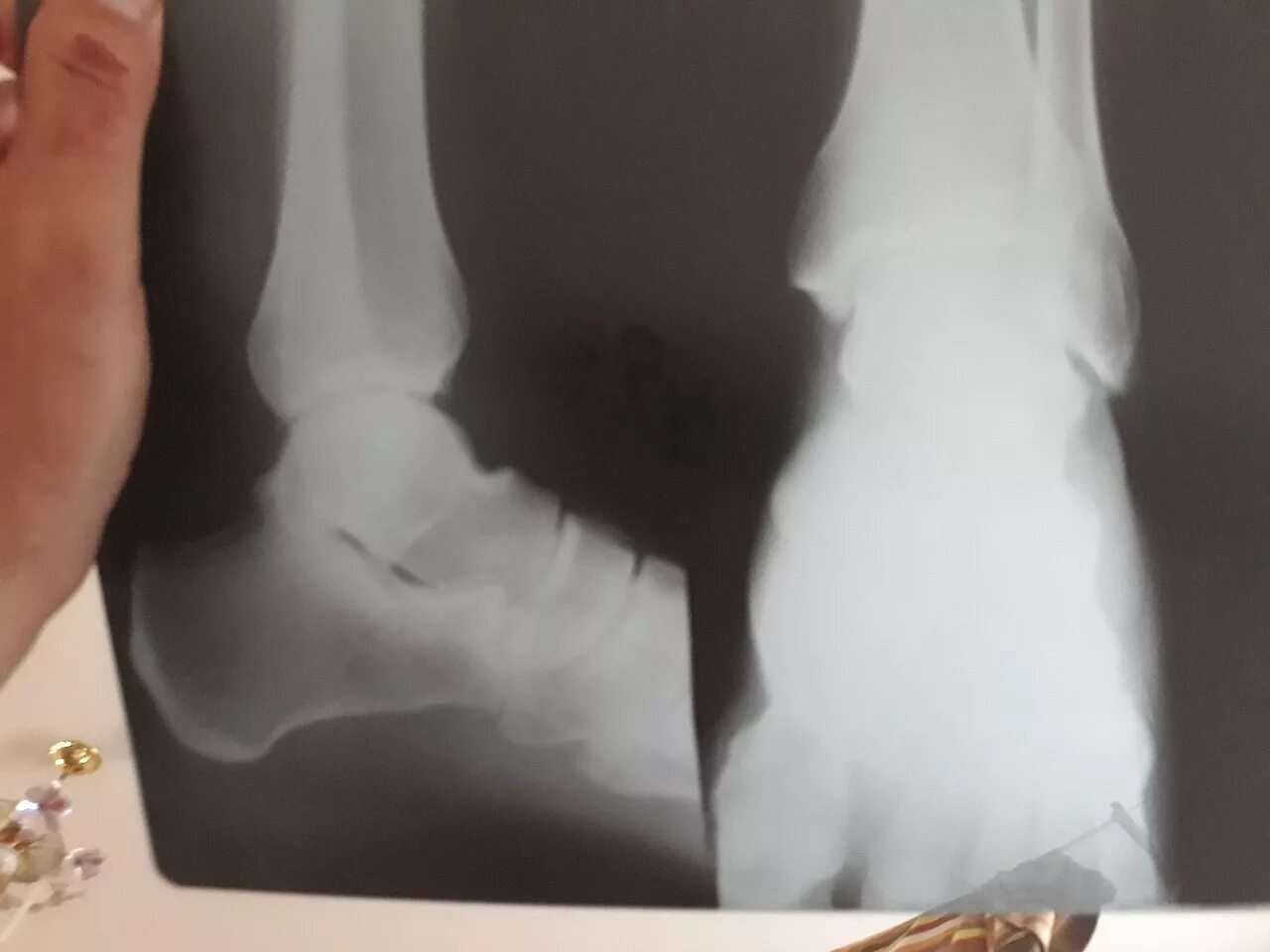 Снимок перелома ноги рентгеновский. Снимок сломанной ноги рентген. Перелом ноги рентген снимки.