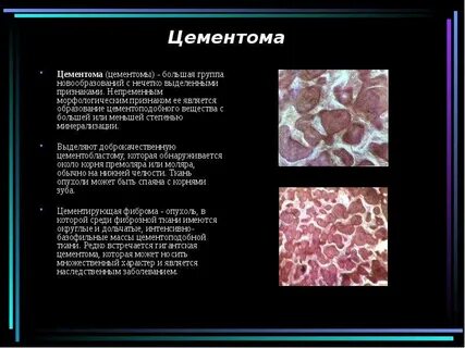 Какая опухоль считается большой