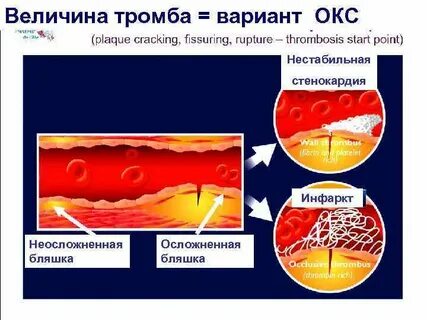Как не допустить тромба