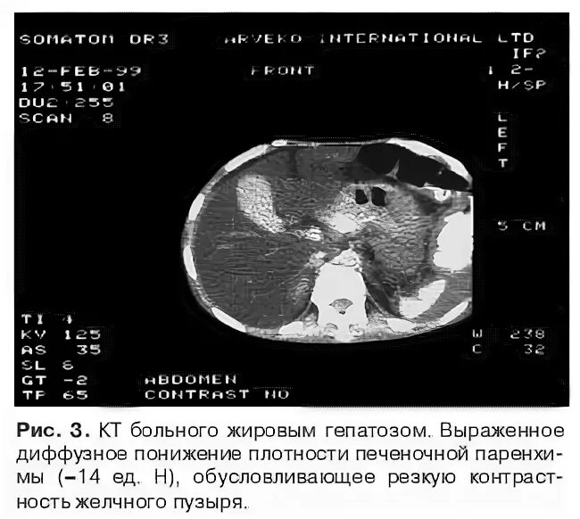 Диффузные изменения паренхимы по типу стеатоза