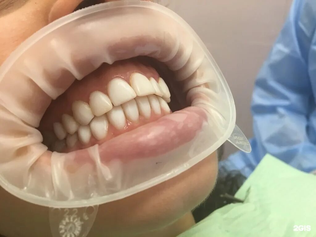 Чистка зубов казань. Чистка зубов у стоматолога.