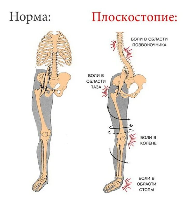 Влияние плоскостопия на коленные суставы. Косолапие и плоскостопие. Стопа и позвоночник. Осложнения плоскостопия. Поясница нога отнимается