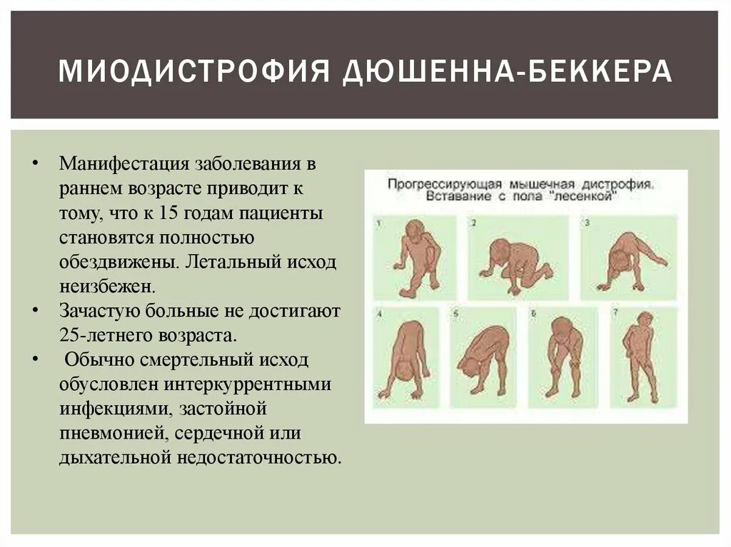 Мышечная дистрофия у детей симптомы. Мышечная дистрофия дюшенна тип наследования. клинические признаки дистрофии дюшенна. псевдогипертрофическая мышечная дистрофия дюшенна. псевдогипертрофическая миопатия дюшенна / беккера.