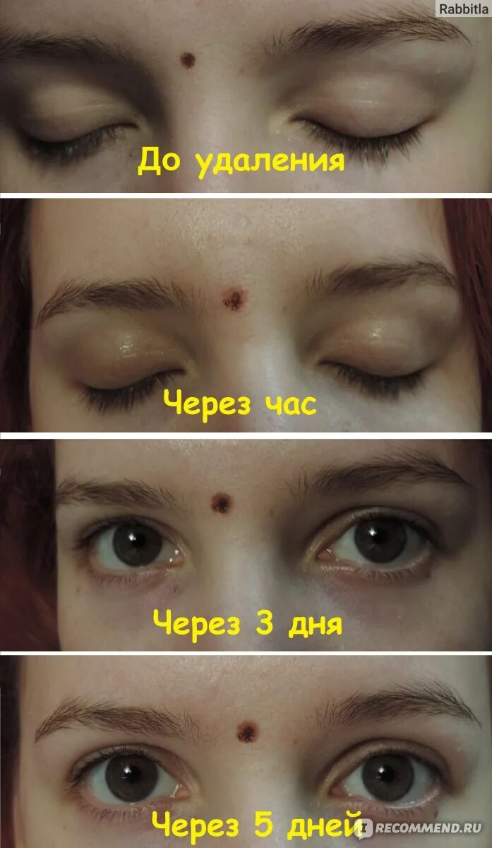 Лазерное удаление (коагуляция) сосудов на лице - "Лазерное удаление сосудов на л