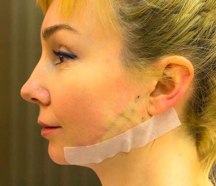 Как снять послеоперационные швы. Как снять послеоперационные швы. Как снять швы самостоятельно в домашних условиях. Удаление нитки после операции. Шов саморассасывающимися нитками.