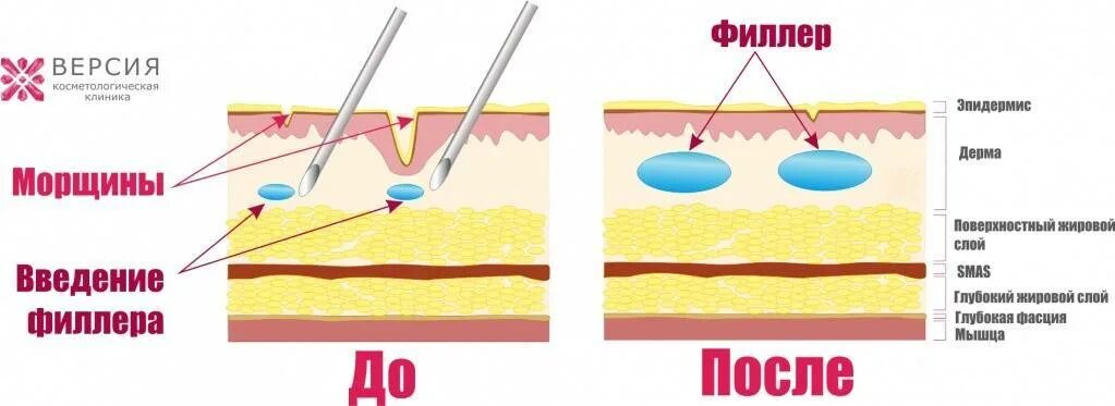 Методика введениния филеров. Методики введения филлеров. Глубина введения филлера. Схема кожи для введения филлеров.