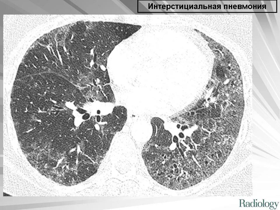 Интерстициальное поражение легких. Идиопатичесаая интерстицианльнвя пневлсния кт. Обычная интерстициальная пневмония на кт легких. Неспецифическая интерстициальная пневмония кт. Эмфизема легких кт.