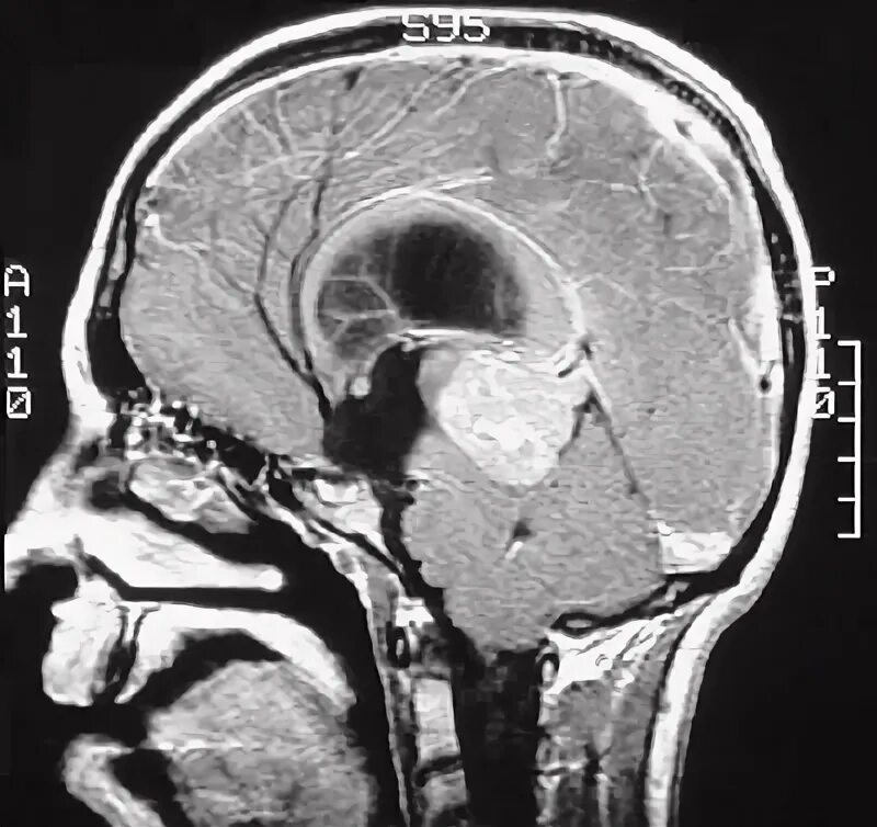 Герминома. Киста пинеальной области на мрт. Коллоидная киста головного мозга на кт. Герминома пинеальной области мрт. Пинеальная область в головном мозге.