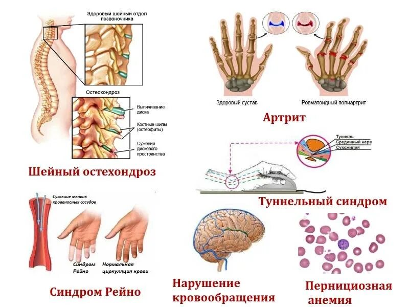 Почему немеют пальцы что делать. Препараты при онемении пальце руки. Нервные окончания на пальцах рук.