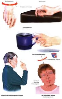 Интенционное дрожание