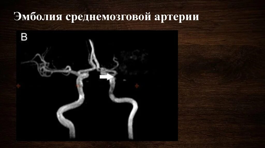 Тромбоэмболия сосудов головного мозга. Тромбоэмболия мозговой артерии. Ангиография сосудов головного мозга. Эмболия мозговых сосудов. Тромбоз артерий мозга