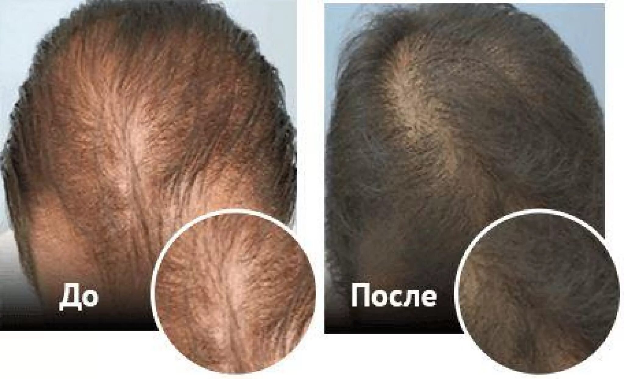 Minoxidil 5 для волос. Миноксидил для роста волос бороды 5. Миноксидил для волос головы отзывы. Финастерид 1мг от облысения. Миноксидил для волос головы отзывы.
