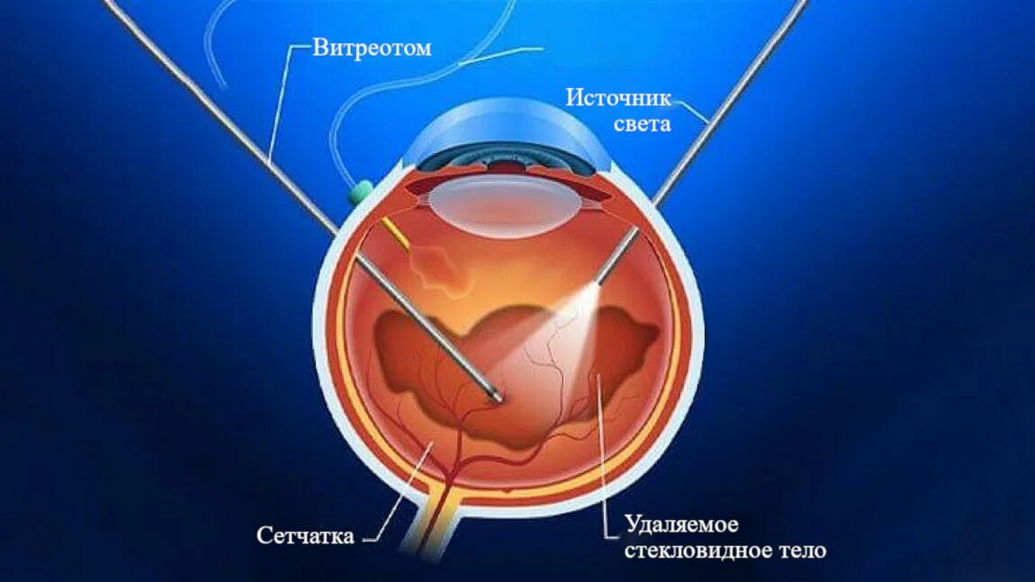 Отслойка сетчатки витрэктомия. Витрэктомия сетчатки глаза. Витрэктомия при отслойке сетчатки. Стекловидное тело операция