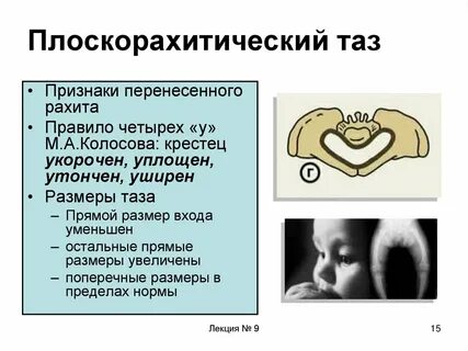 Плоский таз размеры