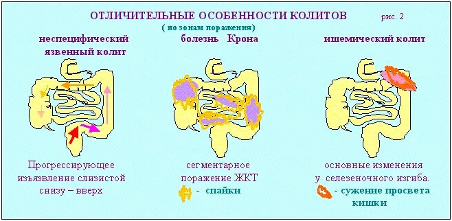 Какие симптомы при колите. Неспецифический язвенный колит кишка. спастический язвенный колит хронический. неспецифический язвенный колит характерный симптом. язвенный колит кишечника симптомы.