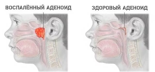 Аденоиды признаки. Гипертрофия носоглоточной миндалины (аденоиды). Носоглотка воспаление аденоиды.