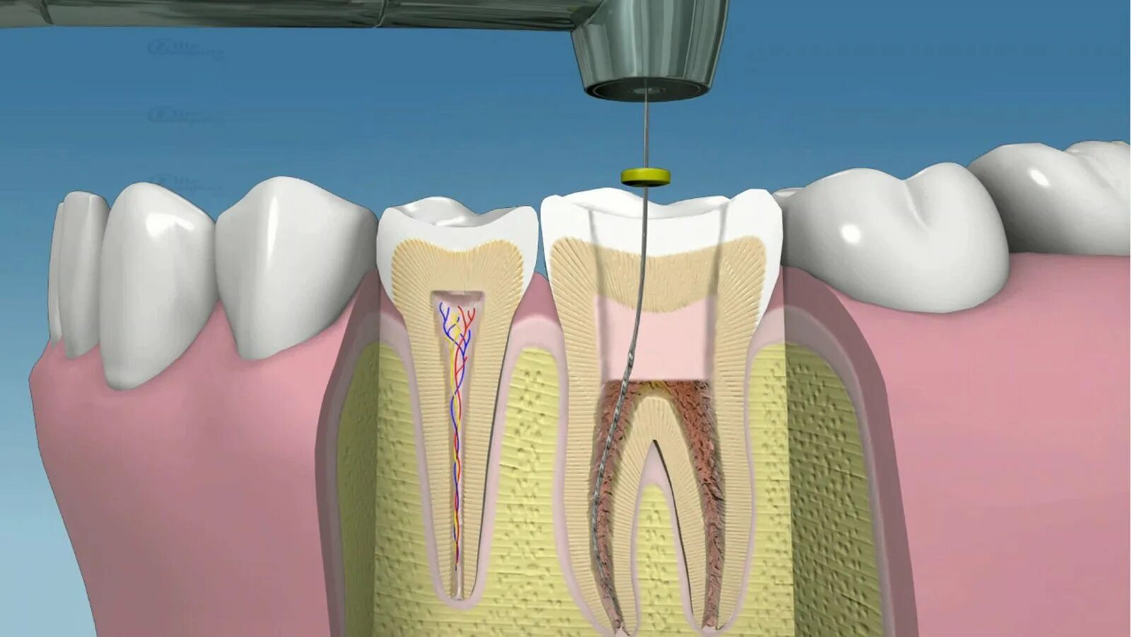 Root canal. Четырехканальный пульпит. Многокорневой пульпит.