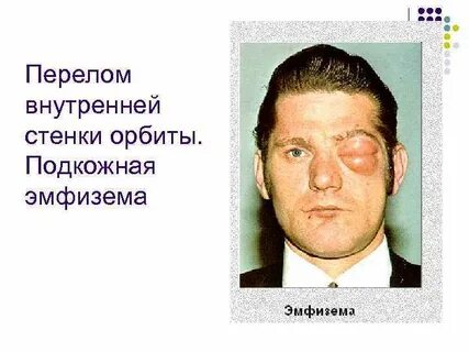Эмфизема в стоматологии