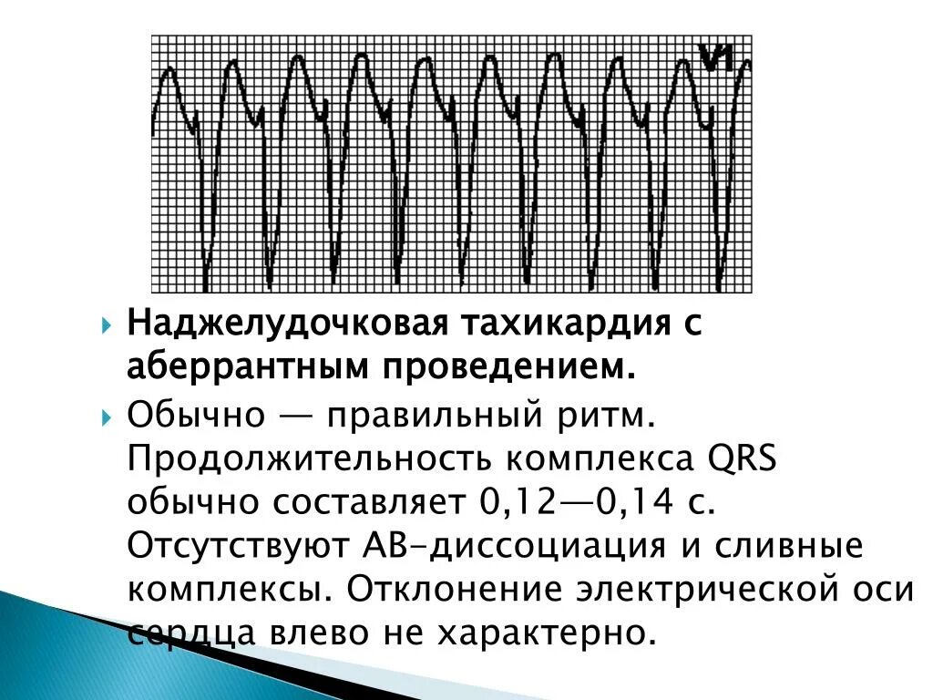 Какие анализы при тахикардии. Наджелудочковая тахикардия на экг. пароксизмальная наджелудочковая тахикардия экг. экг при пароксизмальной наджелудочковой тахикардии. пароксизмальная наджелудочковая тахикардия симптомы.