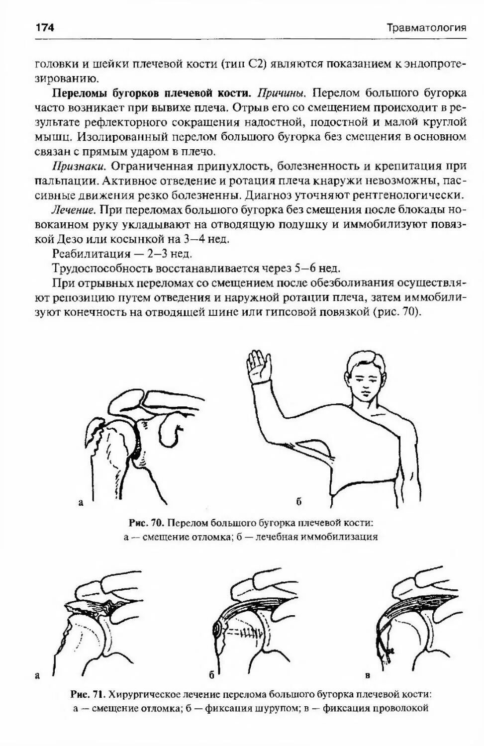 Авульсионный перелом большого бугорка плечевой кости. Перелом плечевой кости с отрывом большого бугорка. Оскольчатый перелом большого бугорка плечевой кости. Перелом большого бугорка плечевой кости без смещения иммобилизация. Перелом головки плечевой кости на кт.